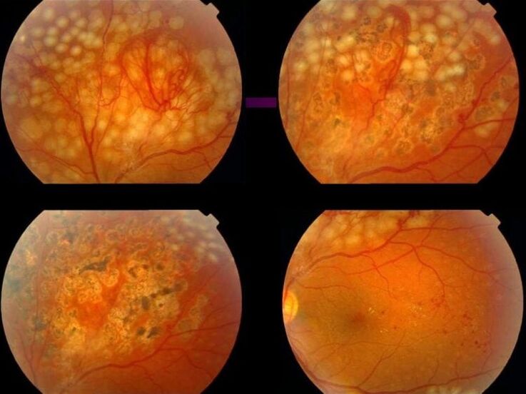 Hipertansiyona bağlı retinopati